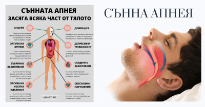 Сънна апнея: симптоми, диагностициране и лечение